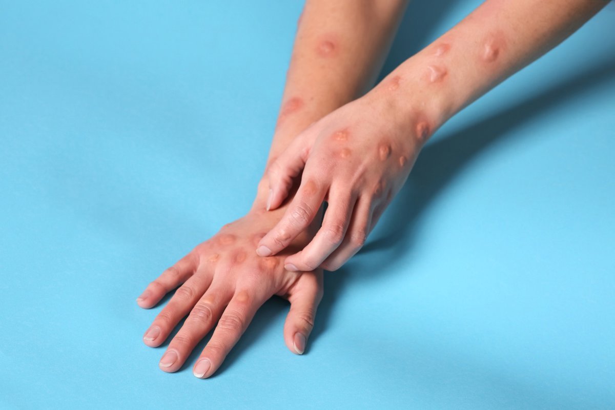 La OMS advierte sobre el peligro de transmisión sostenida del mpox en comunidades