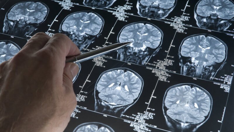 Detectan señales en el cerebro que podrían prever el Alzheimer antes de un diagnóstico clínico