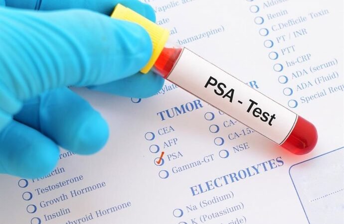 Cáncer de próstata: una herramienta para salvar vidas y evitar tratamientos innecesarios