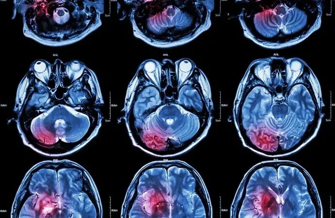 Investigadores hallan que un fármaco ya existente podría frenar el glioblastoma