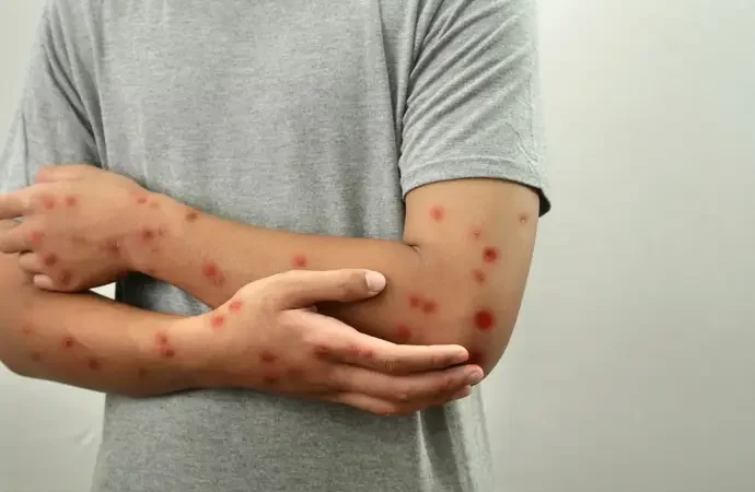 La Red Mundial de Virus alerta sobre el aumento del sarampión y pide fortalecer la vacunación