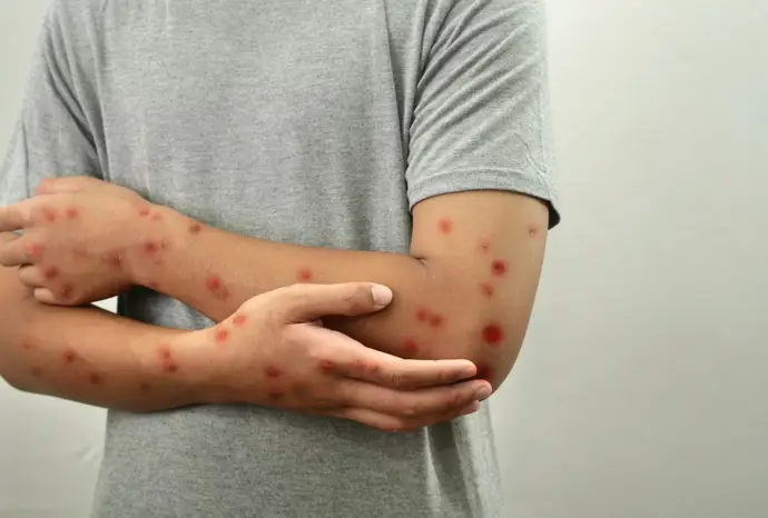 La Red Mundial de Virus alerta sobre el aumento del sarampión y pide fortalecer la vacunación