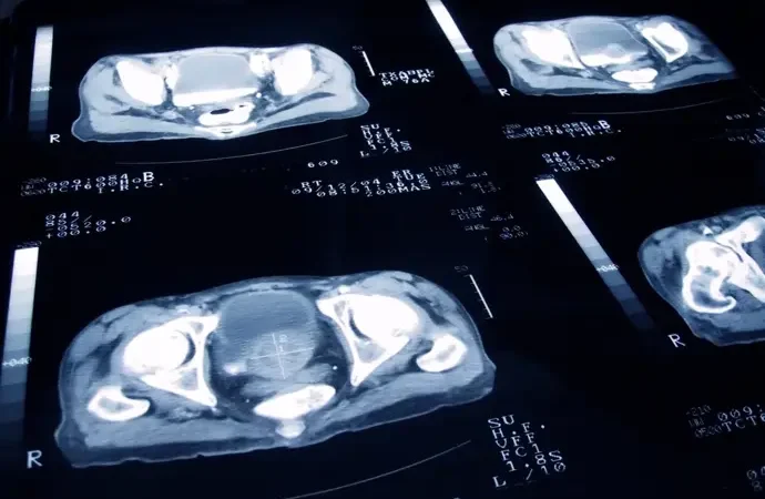 La sangre indica la evolución del cáncer de próstata y el momento en que un tratamiento dejará