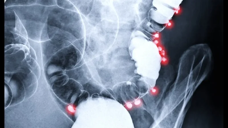 La Fundación del Aparato Digestivo informa que la supervivencia del cáncer de colon es del 90% en