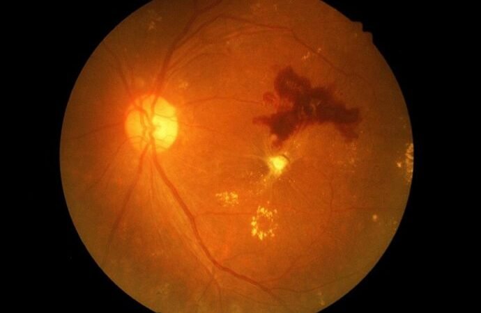 Gotas de semen de cerdo: innovadora estrategia para tratar el cáncer ocular infantil