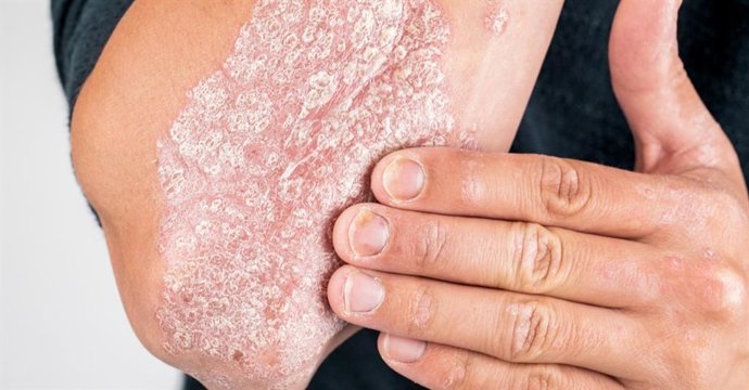 El misterio de la psoriasis y su ‘memoria’ en la piel revelado por científicos expertos en