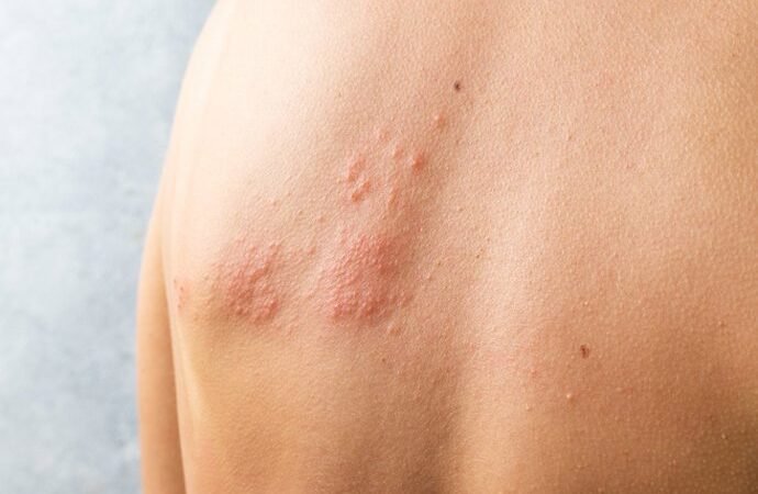 El coste anual del herpes zóster supera los 121 millones de euros en grupos vulnerables, según un