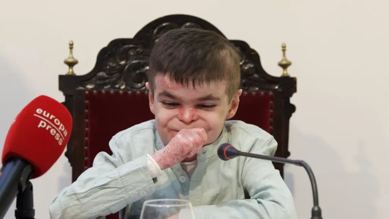 España aplica por primera vez una terapia génica a dos pacientes con Piel de Mariposa